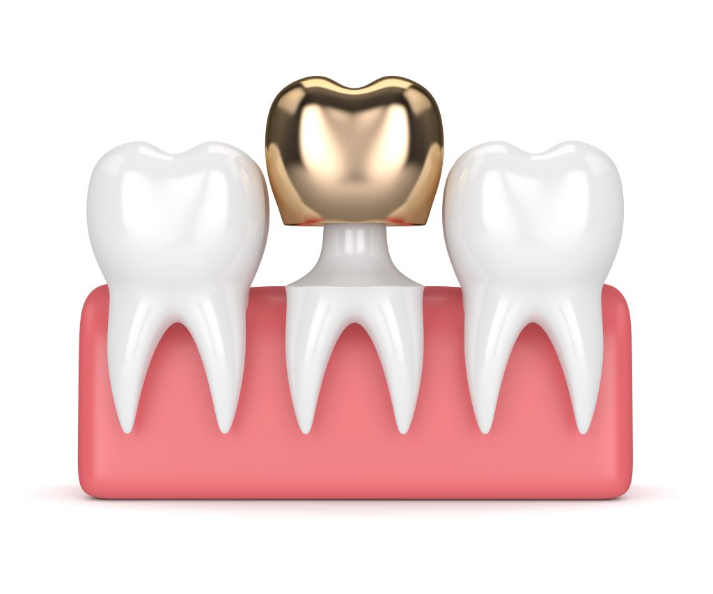 Gold Crowns Dr. Les Ledbetter DDS. Ledbetter Family Dental Care General, Cosmetic, Restorative, Preventative, Pediatric, Family Dentist in Ardmor, OK 73401 and Wynnewood, OK 73098