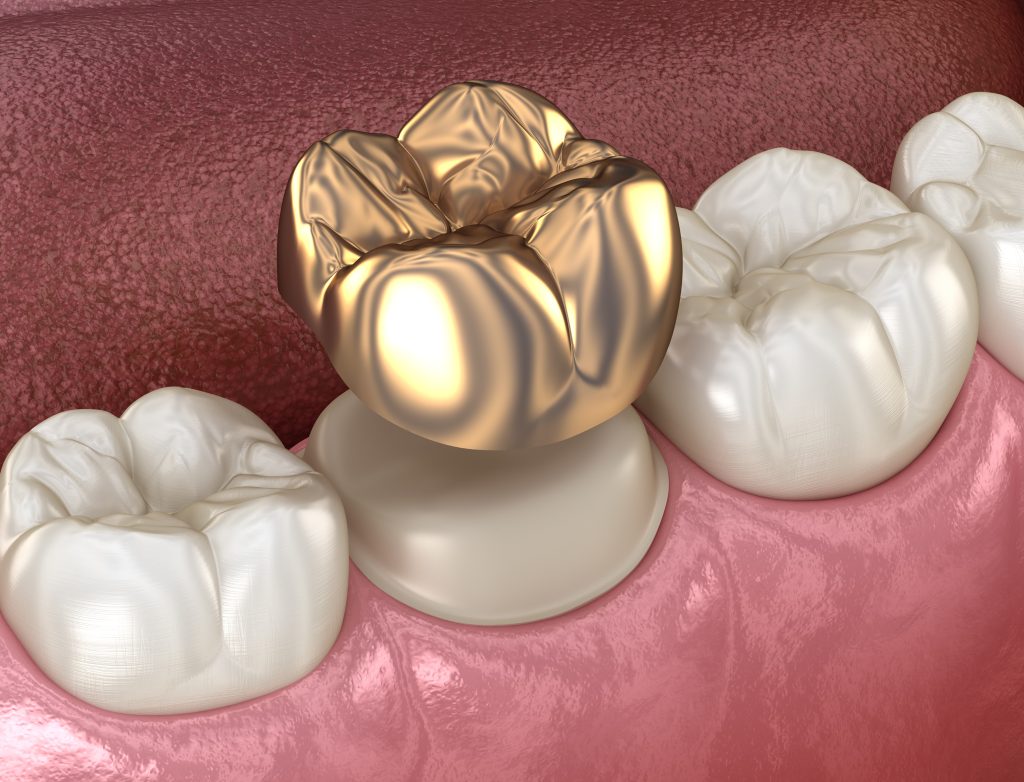 Gold Crowns Dr. Les Ledbetter DDS. Ledbetter Family Dental Care General, Cosmetic, Restorative, Preventative, Pediatric, Family Dentist in Ardmor, OK 73401 and Wynnewood, OK 73098
